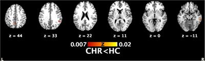 Neural Correlates of Mentalizing in Individuals With Clinical High Risk for Schizophrenia: ALE Meta-Analysis